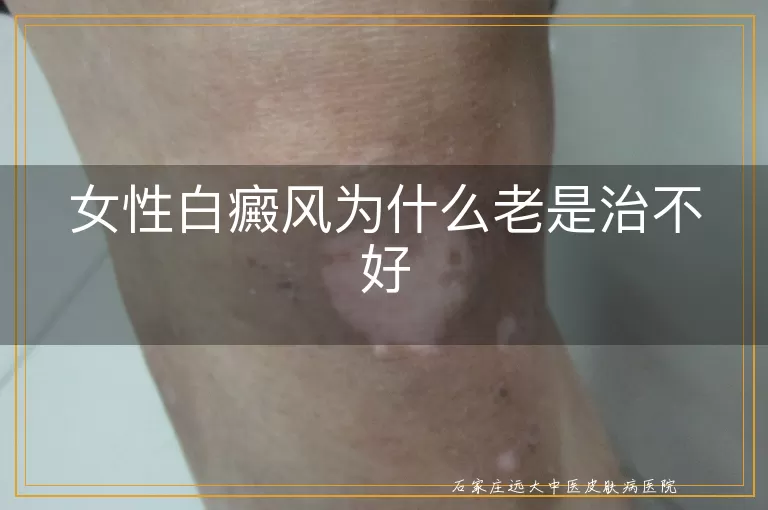女性白癜风为什么老是治不好