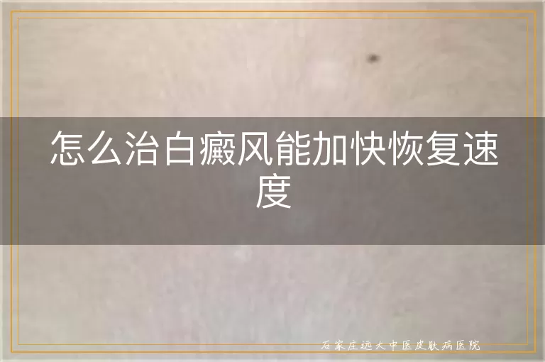 怎么治白癜风能加快恢复速度