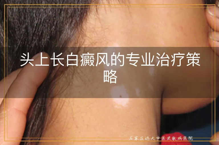 头上长白癜风的专业治疗策略