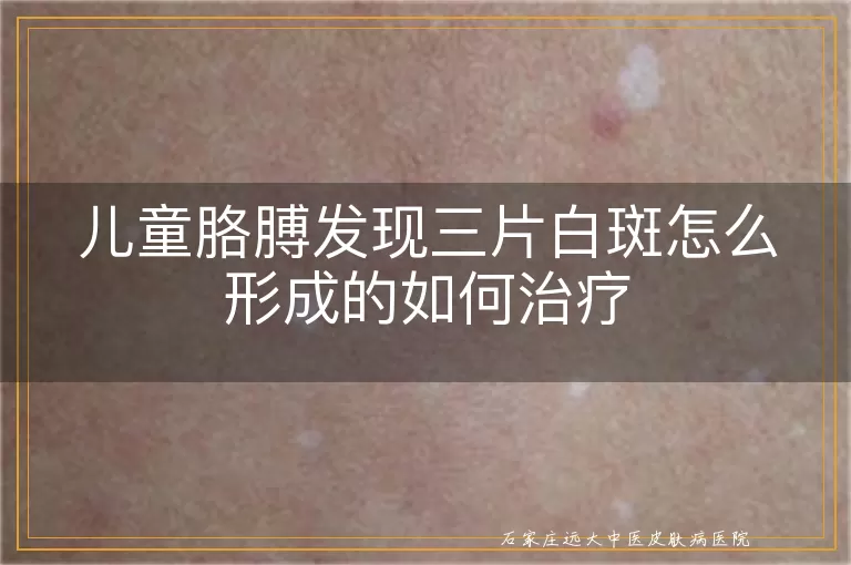 儿童胳膊发现三片白斑怎么形成的如何治疗