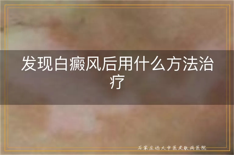 发现白癜风后用什么方法治疗