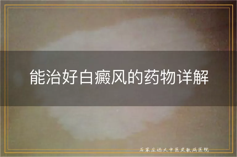 能治好白癜风的药物详解