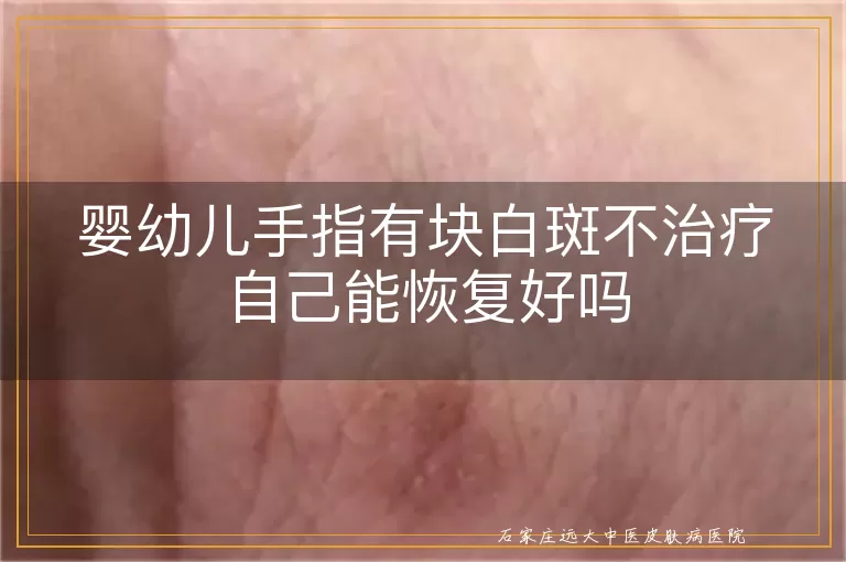 婴幼儿手指有块白斑不治疗自己能恢复好吗