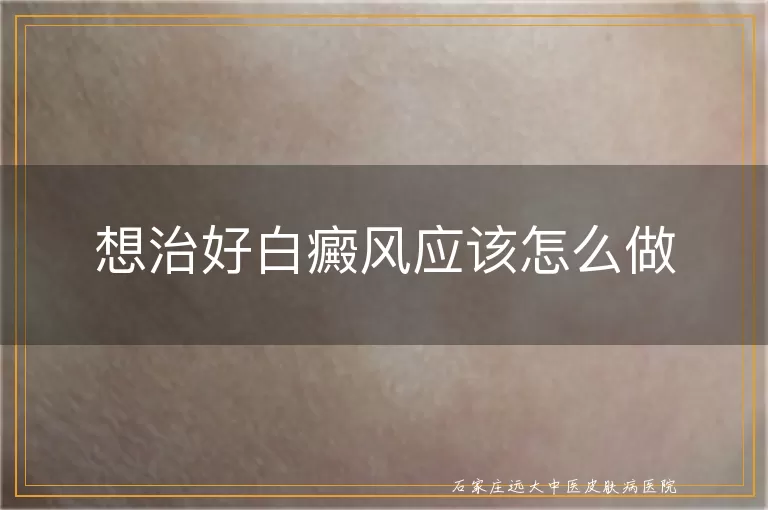 想治好白癜风应该怎么做