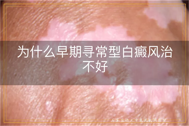 为什么早期寻常型白癜风治不好