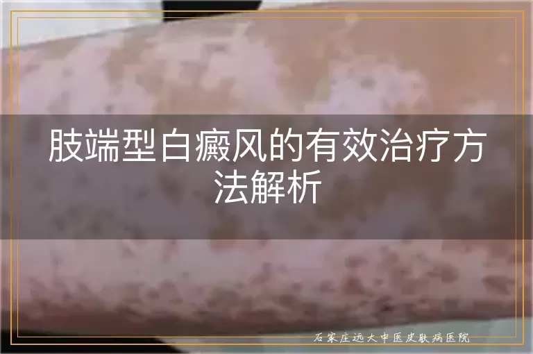 肢端型白癜风的有效治疗方法解析