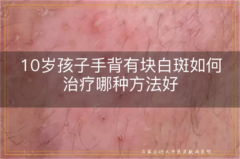 10岁孩子手背有块白斑如何治疗哪种方法好