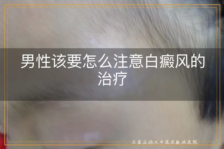 男性该要怎么注意白癜风的治疗