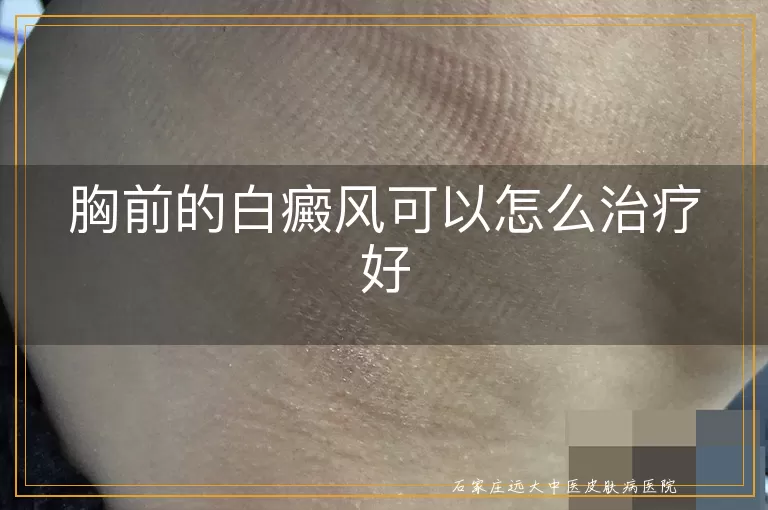 胸前的白癜风可以怎么治疗好