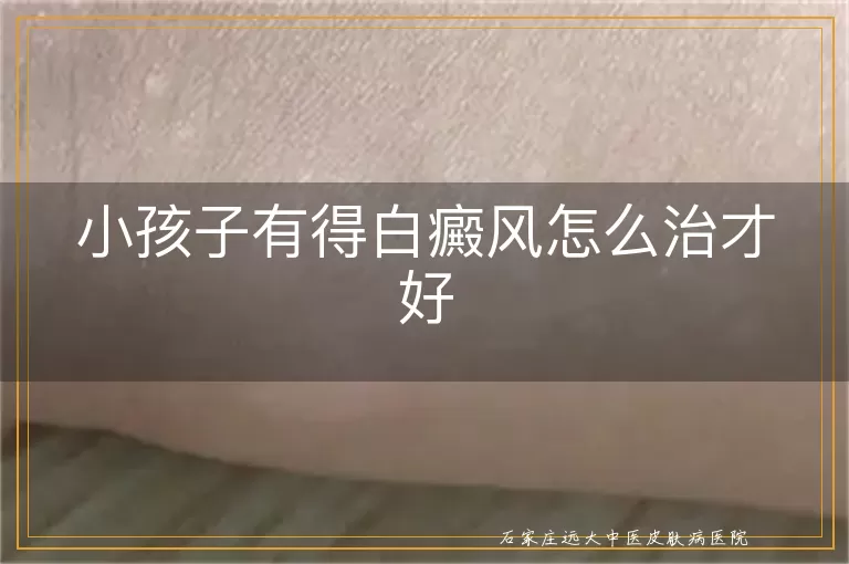 小孩子有得白癜风怎么治才好