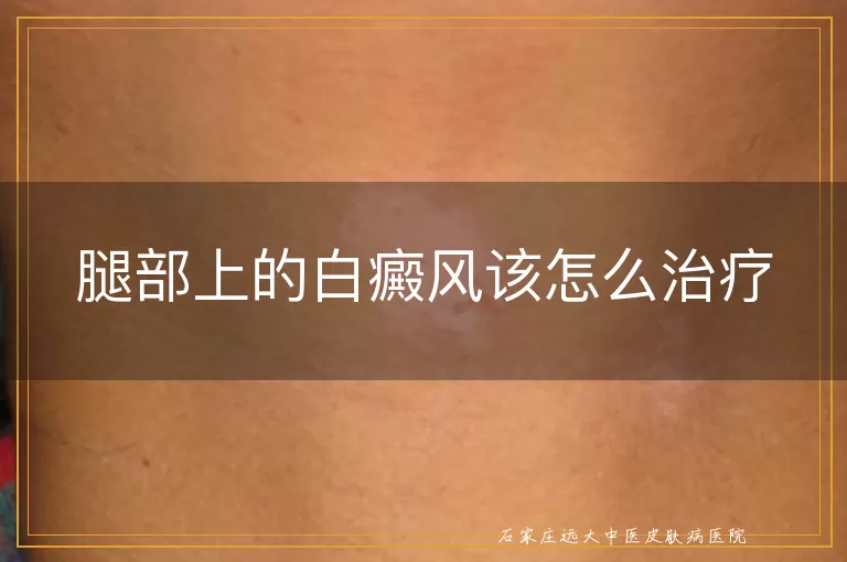 腿部上的白癜风该怎么治疗