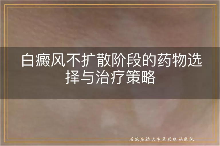 白癜风不扩散阶段的药物选择与治疗策略