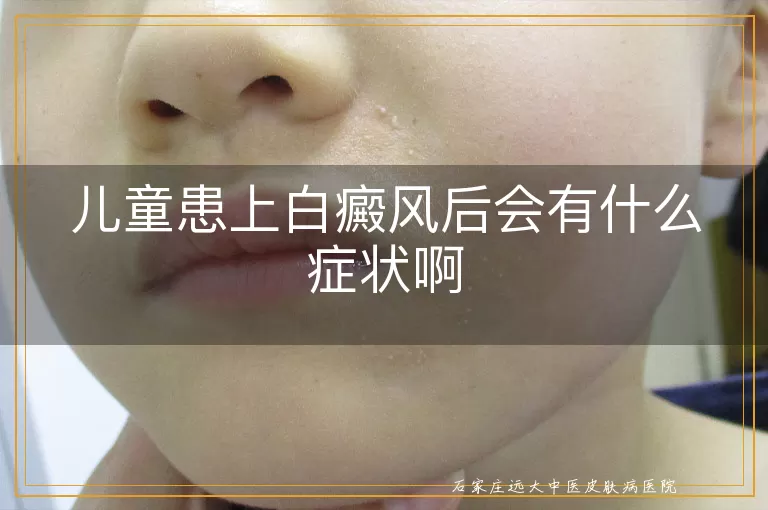 儿童患上白癜风后会有什么症状啊