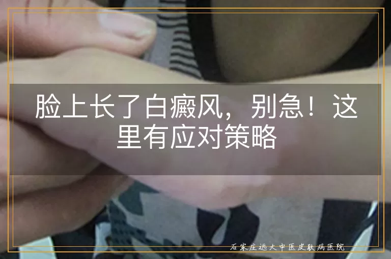 脸上长了白癜风，别急！这里有应对策略