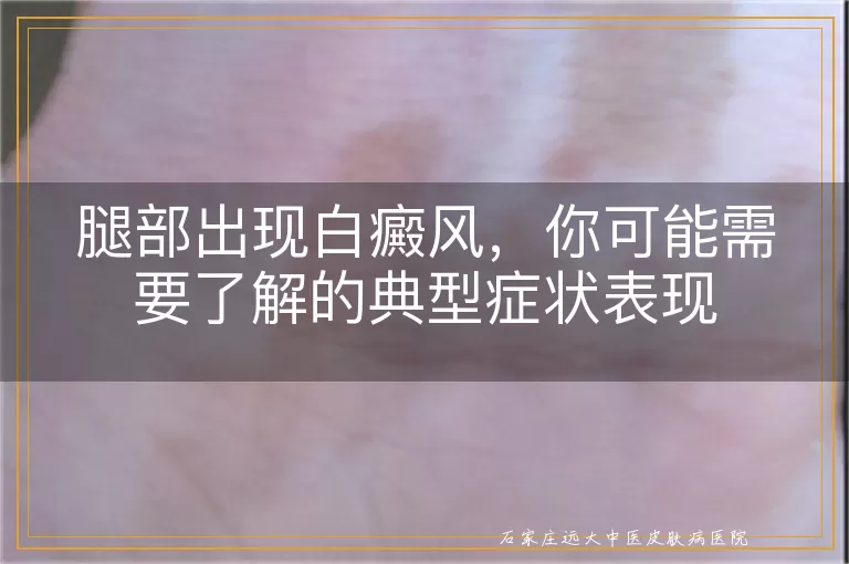 腿部出现白癜风，你可能需要了解的典型症状表现