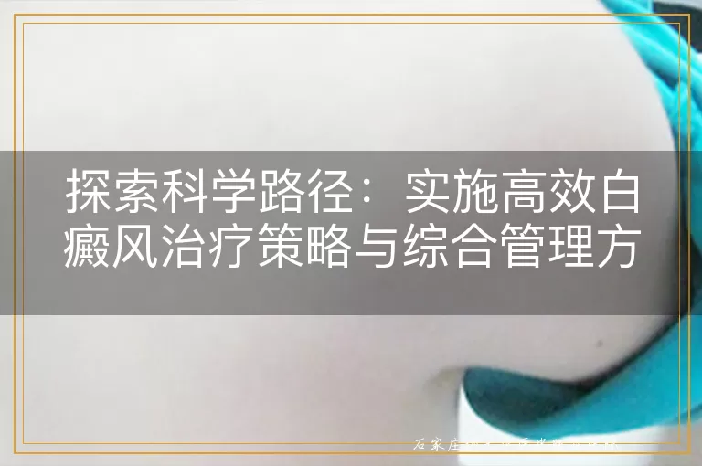 探索科学路径：实施高效白癜风治疗策略与综合管理方案