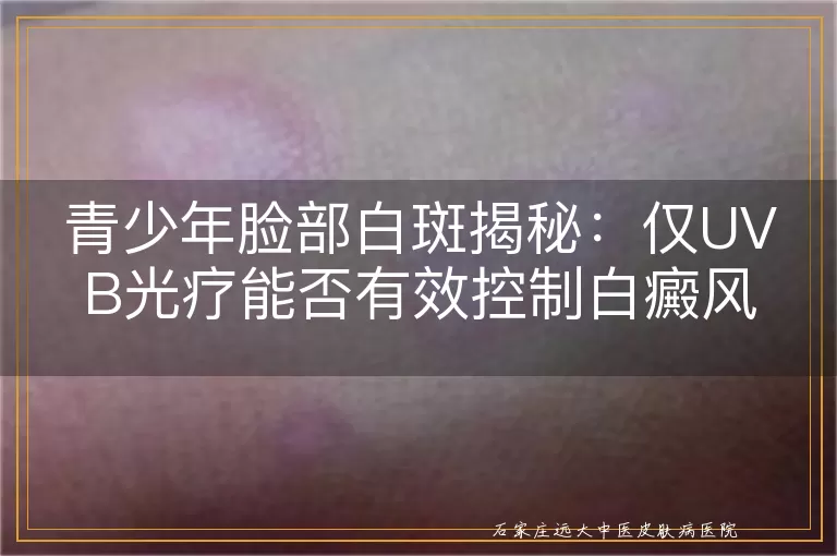 青少年脸部白斑揭秘：仅UVB光疗能否有效控制白癜风