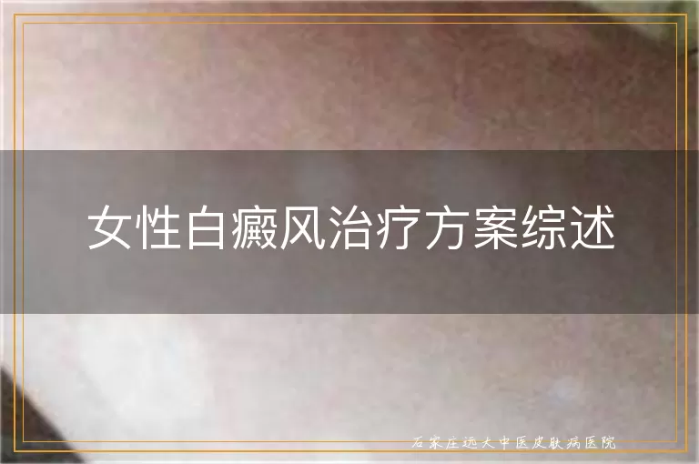 女性白癜风治疗方案综述