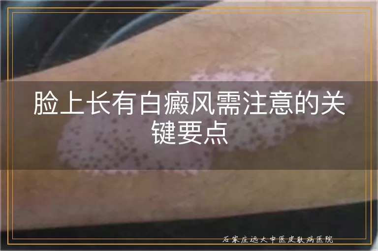 脸上长有白癜风需注意的关键要点