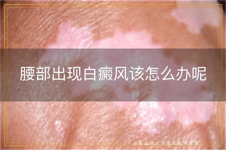 腰部出现白癜风该怎么办呢