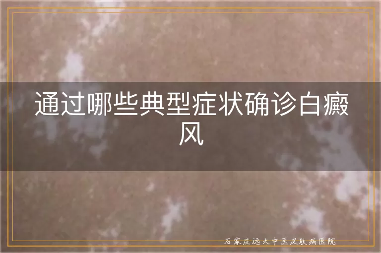 通过哪些典型症状确诊白癜风