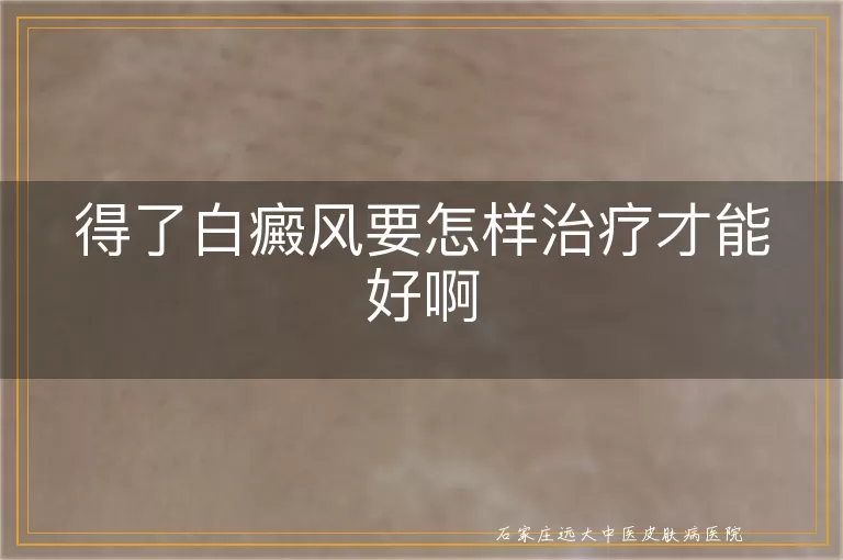 得了白癜风要怎样治疗才能好啊