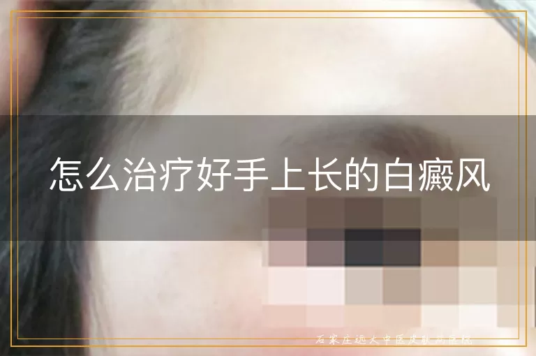 怎么治疗好手上长的白癜风