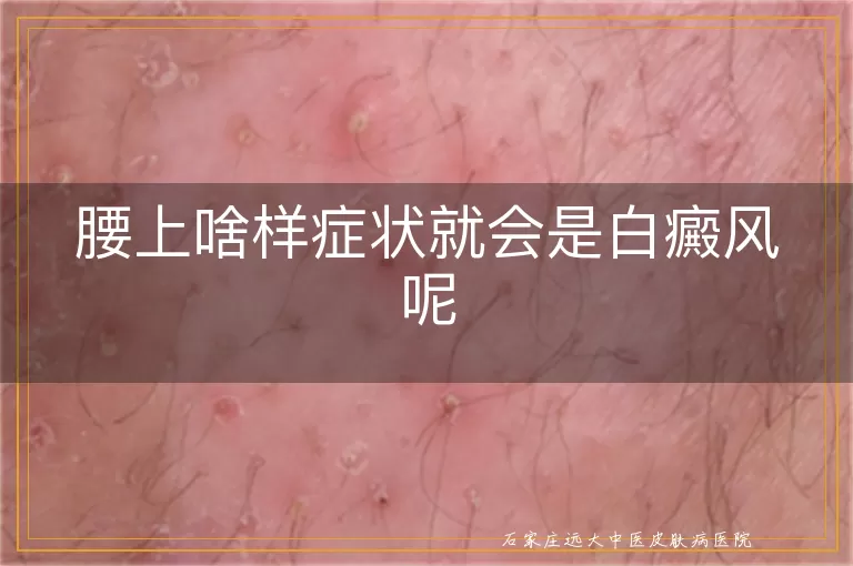腰上啥样症状就会是白癜风呢