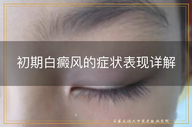 初期白癜风的症状表现详解