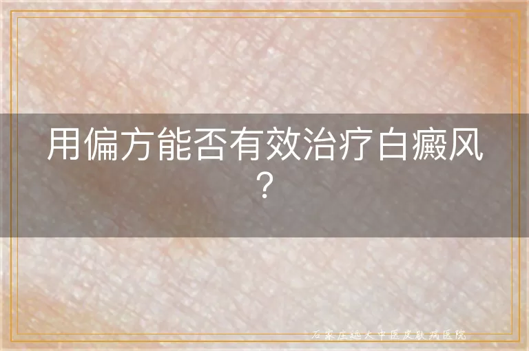 用偏方能否有效治疗白癜风？