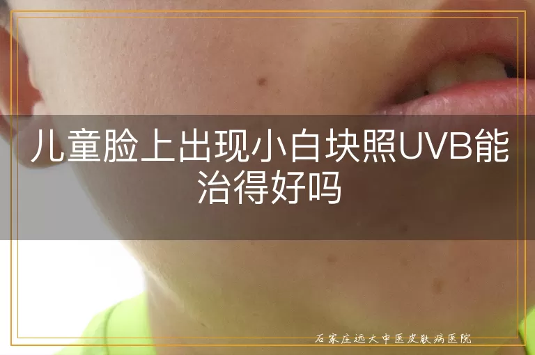 儿童脸上出现小白块照UVB能治得好吗