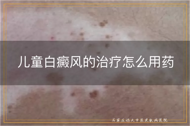 儿童白癜风的治疗怎么用药