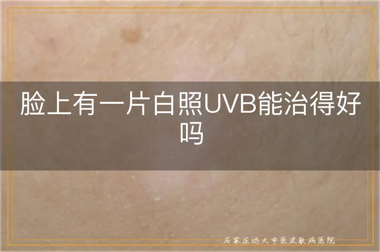 脸上有一片白照UVB能治得好吗