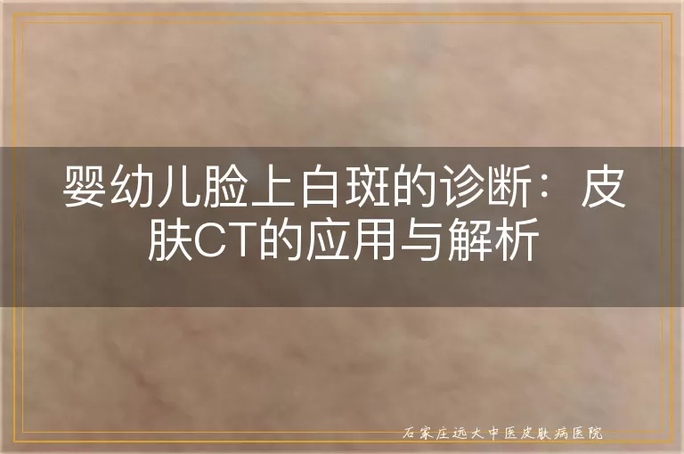 婴幼儿脸上白斑的诊断：皮肤CT的应用与解析
