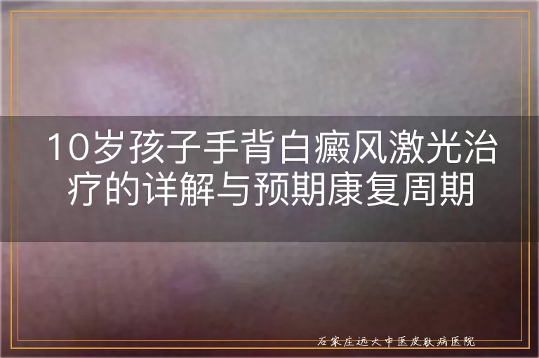 10岁孩子手背白癜风激光治疗的详解与预期康复周期