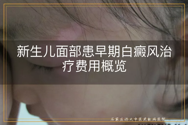 新生儿面部患早期白癜风治疗费用概览