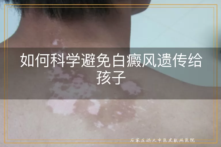 如何科学避免白癜风遗传给孩子