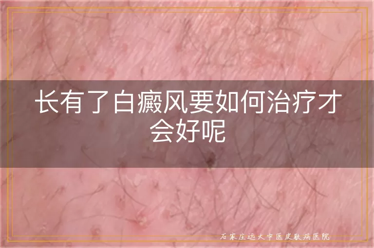 长有了白癜风要如何治疗才会好呢