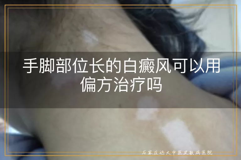 手脚部位长的白癜风可以用偏方治疗吗