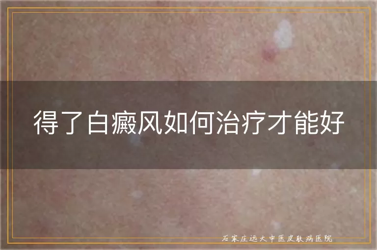 得了白癜风如何治疗才能好