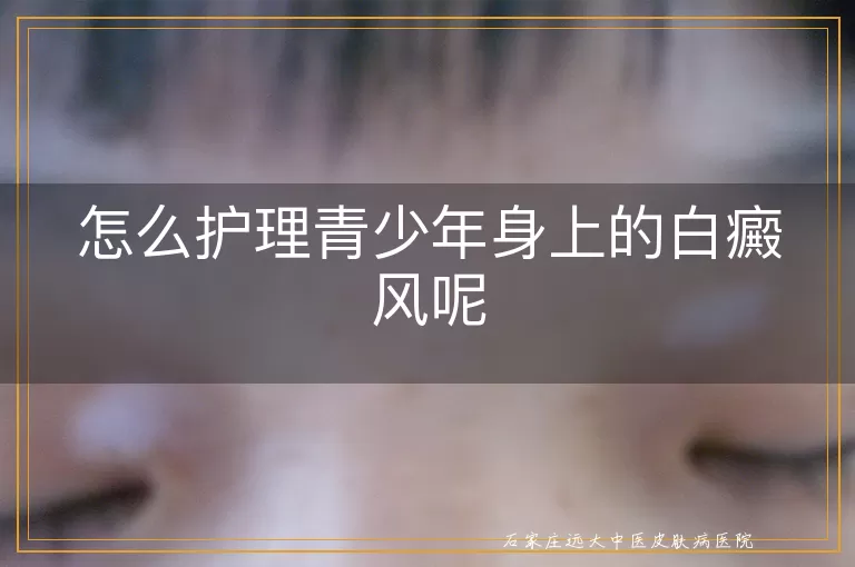 怎么护理青少年身上的白癜风呢