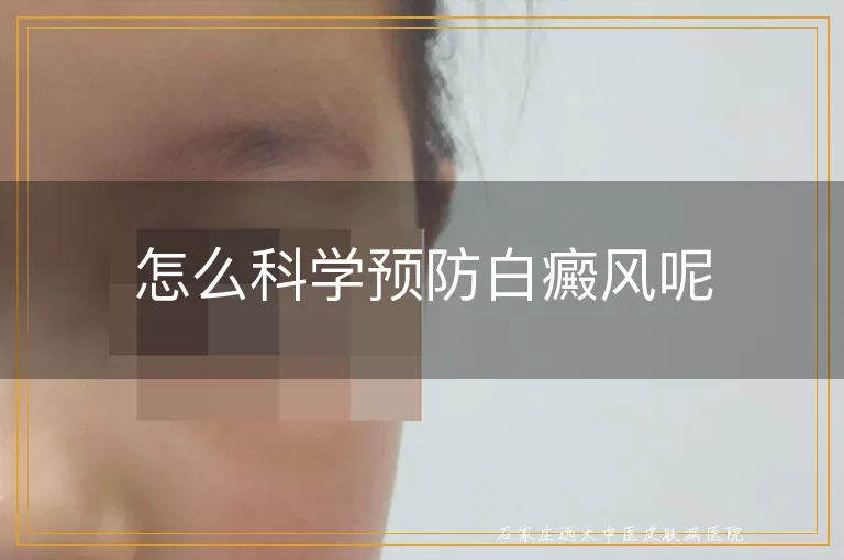 怎么科学预防白癜风呢