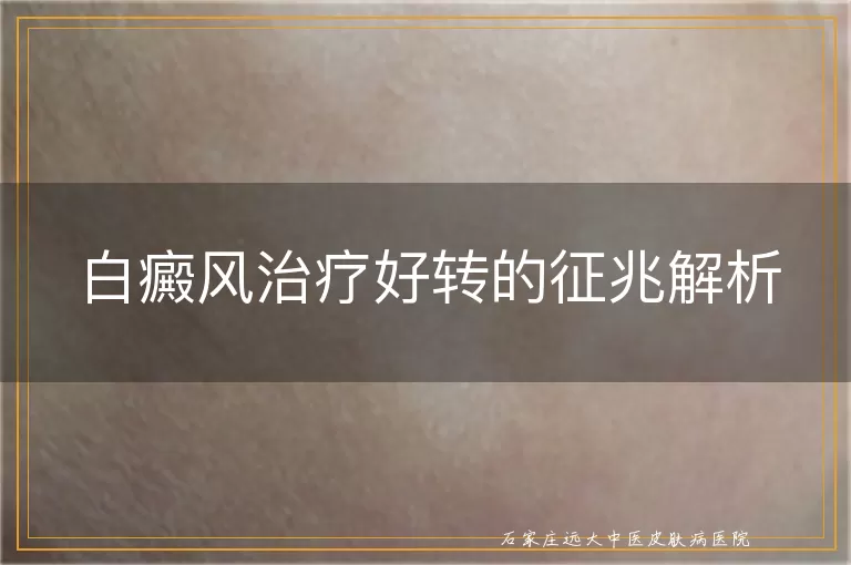 白癜风治疗好转的征兆解析