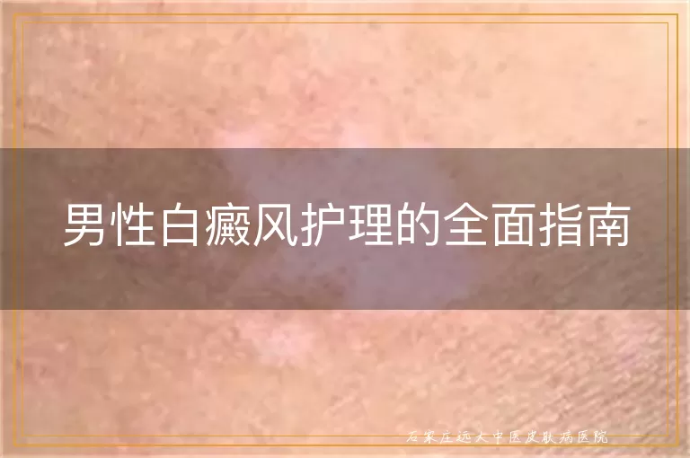 男性白癜风护理的全面指南