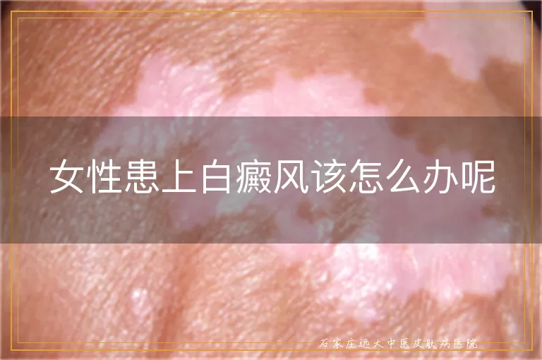女性患上白癜风该怎么办呢