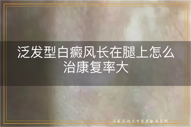 泛发型白癜风长在腿上怎么治康复率大