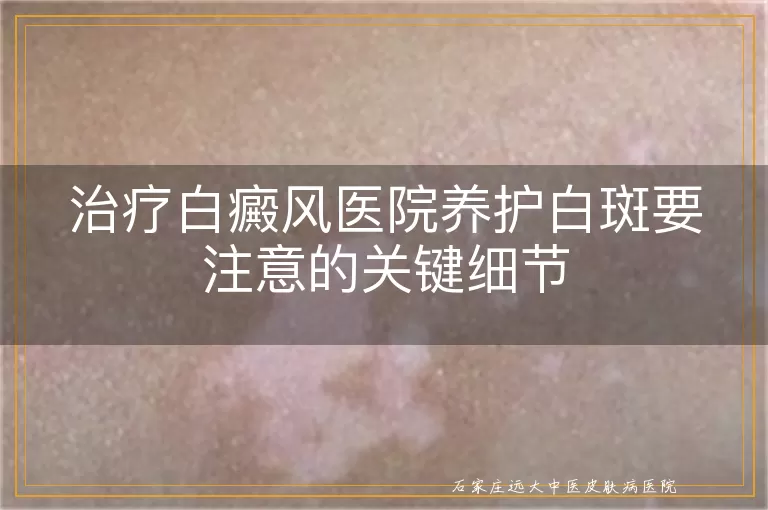治疗白癜风医院养护白斑要注意的关键细节