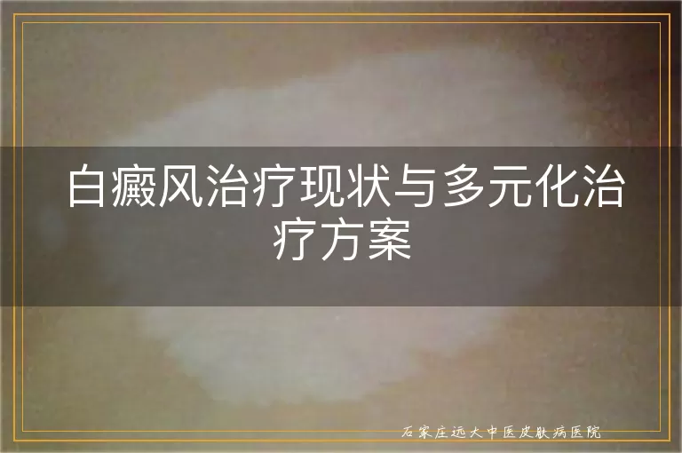 白癜风治疗现状与多元化治疗方案