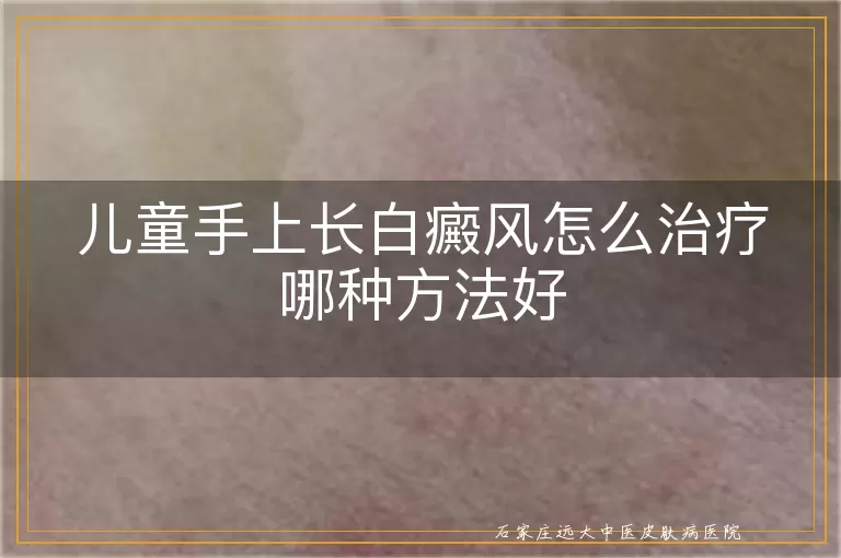 儿童手上长白癜风怎么治疗哪种方法好