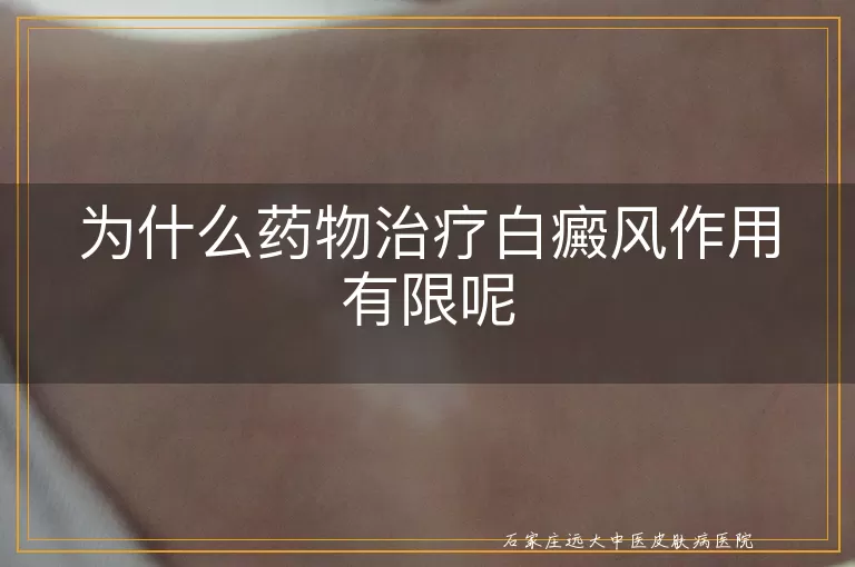 为什么药物治疗白癜风作用有限呢